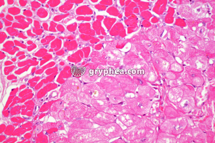 infarctus du myocarde x100 - gryphea.org